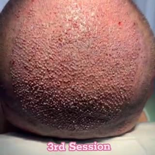 3rd Session – Full Crown Coverage with Maximum Density✨💫
Achieved complete crown coverage with enha