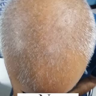 Hair that grows with your confidence. Start your transformation today!
#fyp #HairRestoration #HappyP
