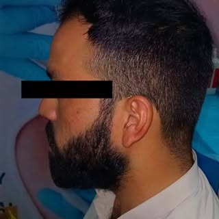 Front hairline and crown — both perfectly restored for a natural, fuller look.
No patches, no worrie