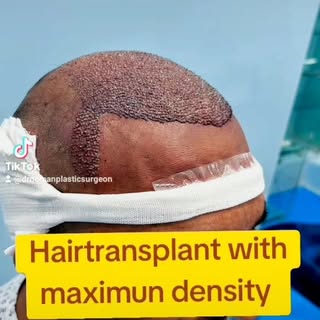 "From thinning to thriving ✨ Watch the magic of hair restoration unfold! 💉💇‍♂️ Say goodbye to hair