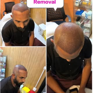 From bandage removal to a brand-new hairline ✨
Real transformation. Real confidence. 💯
Watch the be