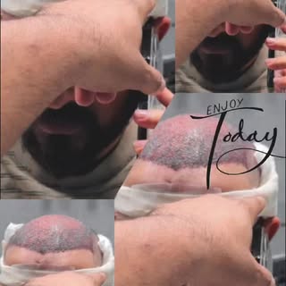 #pakistan #fypreels #viral #hairtransplant #explore