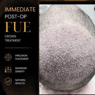This photo shows the immediate results of an FUE hair transplant performed to restore density in the