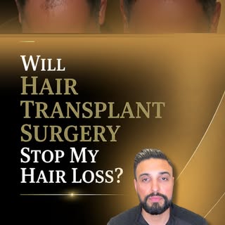 A hair transplant can restore density in areas that have already thinned, but it does not necessaril