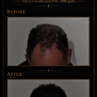Real progress. Real results.

Just 6 months after an FUE hair transplant using approximately 2,900 g