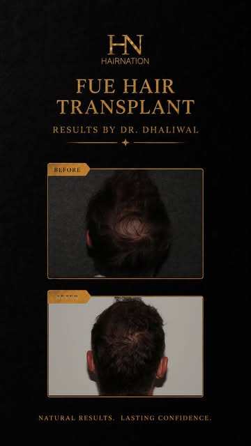 At 11 months post-FUE hair transplant, this patient is showing noticeable improvement in hairline de