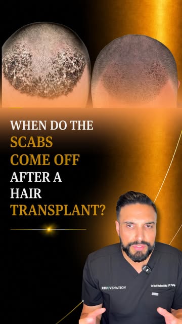 One of the most important rules? Don’t pick, scratch, or aggressively remove the scabs, especially d