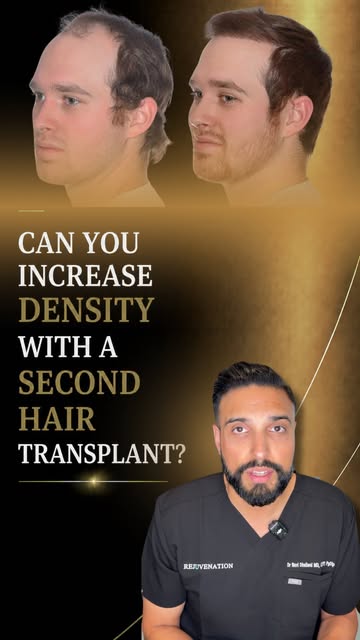 A second hair transplant may be considered when:

• Enough healthy donor hair remains
• Additional g