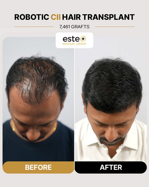 7,461 GRAFTS. A TRANSFORMATION LIKE NO OTHER. 🔥

From noticeable hair loss to a fuller, denser and 