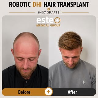 6,407 GRAFTS. ONE INCREDIBLE TRANSFORMATION. 🔥

From significant hair loss to a fuller, stronger an