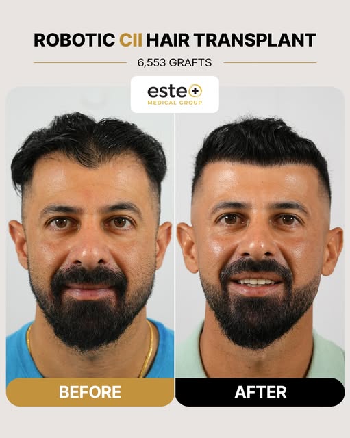 Robotic DHI Hair Transplant Result 🧔‍♂️✨

Total Grafts Transplanted: 6,553

Check out this stunning