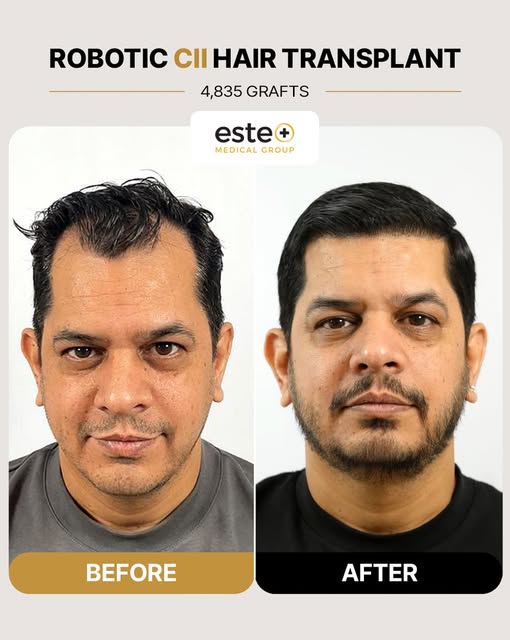 4,835 GRAFTS. A TRANSFORMATION LIKE NO OTHER. 🔥

From noticeable hair loss to a fuller, denser and 