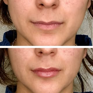 Our gorgeous patient wanted a very natural looking result and we delivered! “My lips but slightly mo