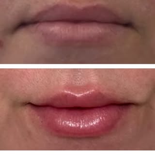 What better way to celebrate the 4th than with stunning lips! More symmetrical and perfectly plump! 