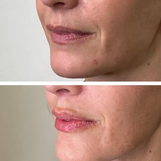 The lips get the attention. The proportions do the work.😍

Lips + strategic midface/piriform suppor