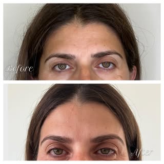Came for the forehead. Stayed for the eyes.

Softer forehead lines + a more open-looking eye area. A