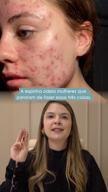 A espinha odeia mulheres que pararam de fazer essas três coisas.
#dermatologista #pele #acne #espinh