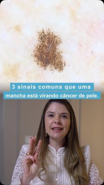 3 sinais comuns que uma mancha está virando câncer de pele!
#dermatologista #pele #cancerdepele