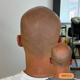 Diz “Adeus 👋🏼” à coroa! 
Filas? Com a Micropigmentação Capilar, a coroa já não é o centro das aten