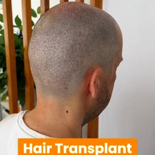 𝐃𝐚𝐬 𝐜𝐢𝐜𝐚𝐭𝐫𝐢𝐳𝐞𝐬 à 𝐜𝐨𝐧𝐟𝐢𝐚𝐧ç𝐚.💥
From scars to confidence.

Após transplante, o no
