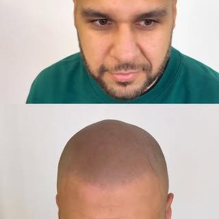 Discreto. Natural. Indetetável.

Cada linha frontal é desenhada de acordo com o teu rosto, e cada se