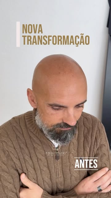 Resultado pedido. Resultado entregue. ✍️

Um caso desafiante, com uma área extensa, uma pele que abs