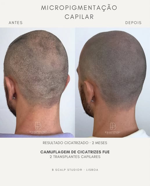Duas cirurgias. Várias cicatrizes FUE. Um resultado pensado para devolver uniformidade à zona dadora