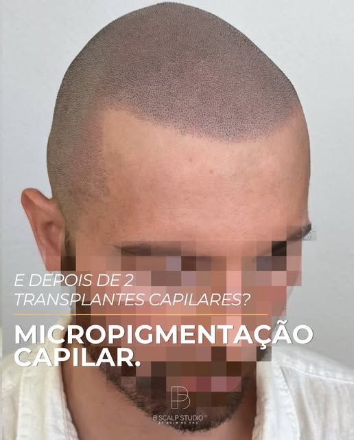 E depois de 2 transplantes capilares? Micropigmentação Capilar.

Depois de dois transplantes capilar