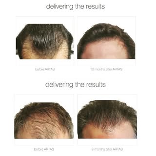 Doctor Richard Chaffoo, MD | California top Neograft specialist surgeon | Call for a free consultati