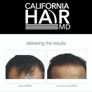 HAIR TRANSPLANT SPECIALIST SURGEON | NEOGRAFT EXPERT call for a free consultation,
@susanstuartmd
@l