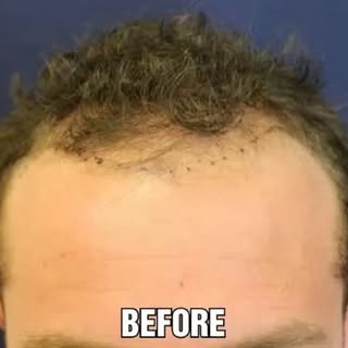 HAIR TRANSPLANT SPECIALIST SURGEON | NEOGRAFT EXPERT. Call for a free online consultation. Link in b