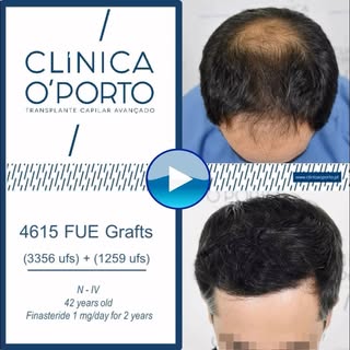 🖥️ 🎬 📺 🎥  En este caso clínico os mostramos una alopecia con Grado Noorwood - IV Vertex abordada