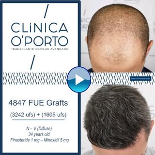 🖥️ 🎬 📺 🎥  En este caso clínico os mostramos una alopecia con Grado Noorwood - V difuso, abodada 