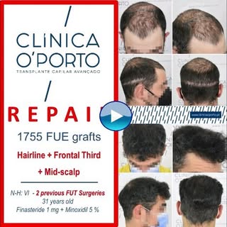 .
📸 🎬 🖥️
A continuación os mostramos una REPARACIÓN de una alopecia grado Norwood VI con patrón d