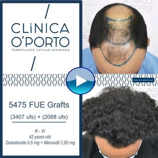 🖥️ 🎬 📺 🎥

En este caso clínico os mostramos una alopecia con Grado Noorwood - VI abordada median