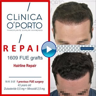 📸 🎬 🖥️
A continuación os mostramos una REPARACIÓN de una alopecia grado Norwood III con 1 Traspla