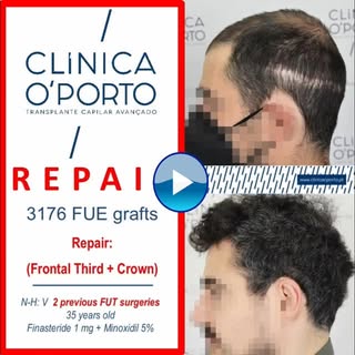 📸 🎬 🖥️
A continuación os mostramos una REPARACIÓN de una alopecia grado Norwood V con 2 Trasplant