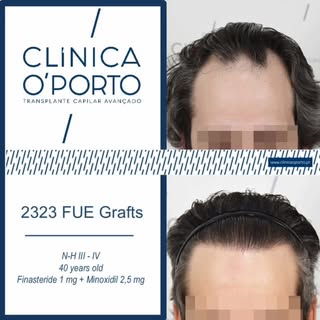 🖥️ 🎬 📺 🎥  En este caso clínico os mostramos una alopecia con Grado Noorwood - III - IV, abordada