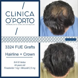 🖥️ 🎬 📺 🎥  En este con caso clínico os mostramos una alopecia de grado Noorwood III - Vertex abor