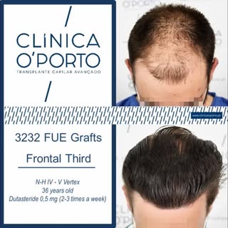 🖥️ 🎬 📺 🎥  En este con caso clínico os mostramos una alopecia de grado Norwood IV - V Vertex abor