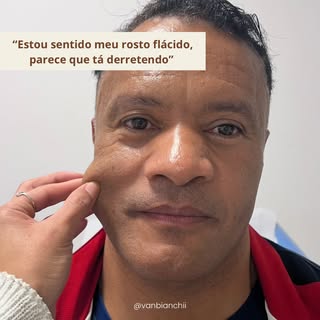 Muitas pessoas acreditam que o bioestimulador entrega todo o resultado no momento da aplicação.

Na 