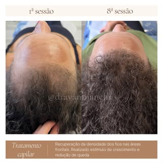 Arraste pro lado e acompanhe a evolução desse caso real 🤎✨ 

#tricología #alopecia #alopeciaandroge