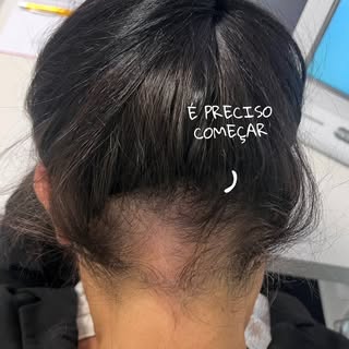 O resultado que você espera, está no passo inicial da sua decisão! 

#tricología #alopecia #estetica