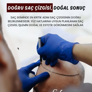 Doğru Saç Çizgisi, Doğal Sonuç!

Saç ekiminde en kritik adım saç çizgisinin doğru belirlenmesidir. Y