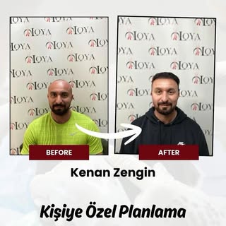 Mutlu danışanlar, başarılı sonuçlar ✨

#saçekimi #hairtransplant #hairclinic #saçekimtürkiye