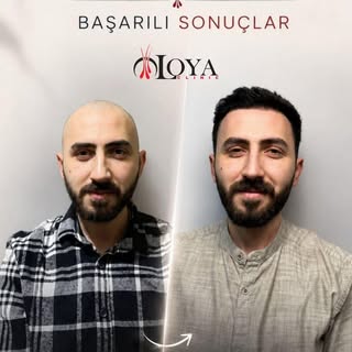 Mutlu danışanlar.
Başarılı sonuçlar. ✨

Her dönüşüm, yeniden gelen bir özgüven hikayesi.

#sacekimi 
