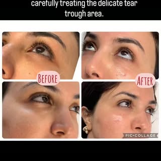 Tired of looking tired? ✨
​Swipe to see the beautiful, subtle transformation for this lovely client.