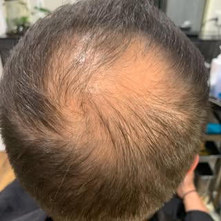 #baldnesscure #menshairloss #menshairlosssolutions #hairreplacement #hairreplacementsystem #hairrepl