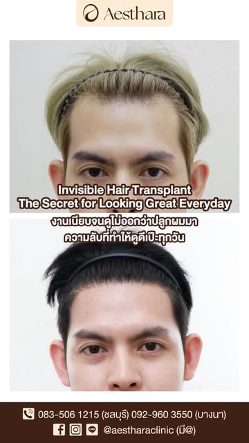👀 Had a hair transplant… but no one can tell?

✨ Here’s another real case review featuring our Non-