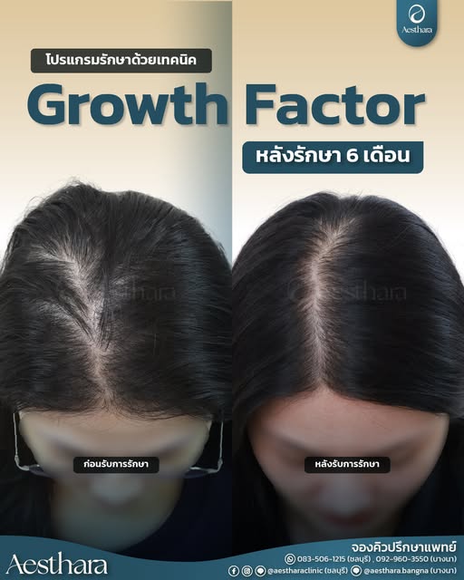 ✨ รีวิวเคสผู้หญิง โปรแกรมรักษาด้วยเทคนิค Growth Factor ครบ 6 เดือน ✨

อีกหนึ่งเคสที่ติดตามผลการดูแลป